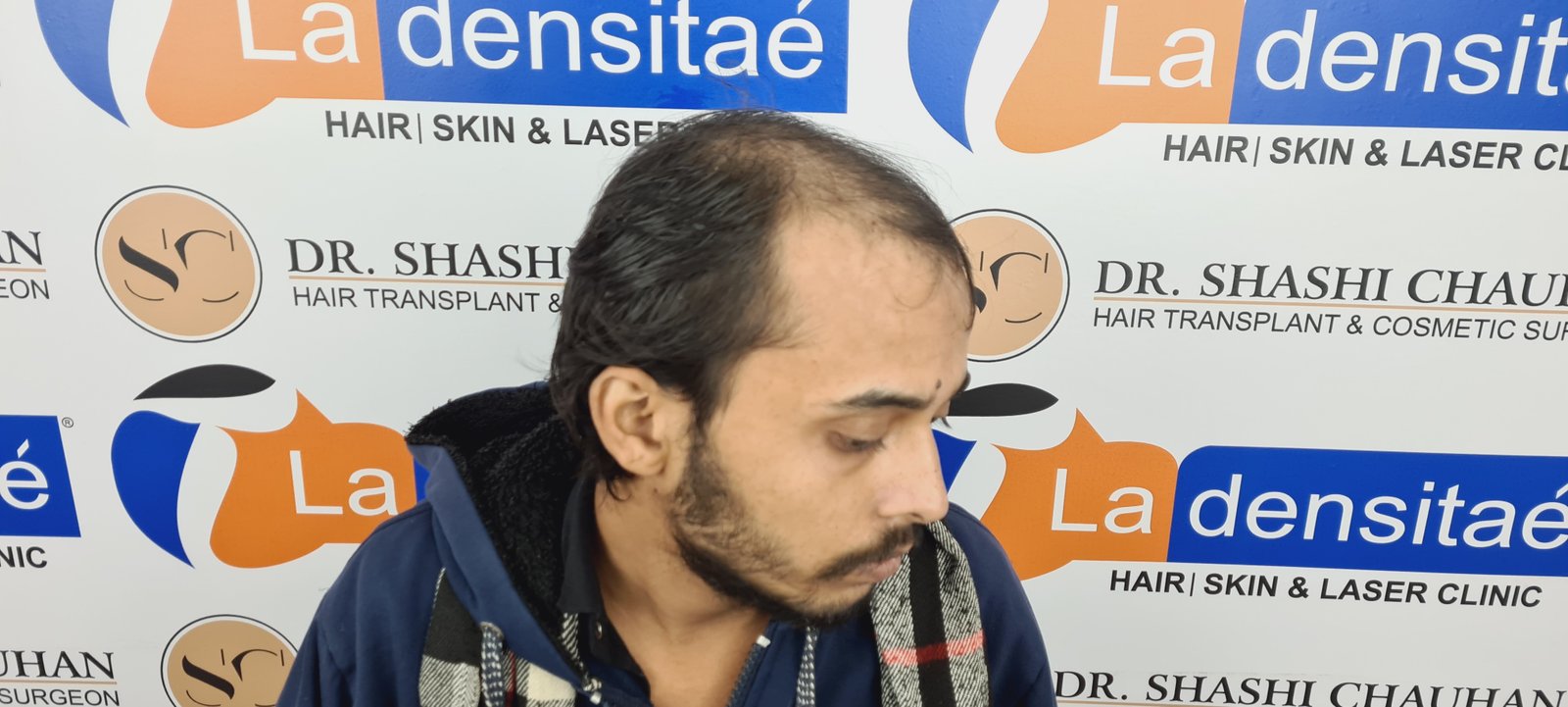 Ashis Yadav Before Hair Transplant